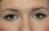 Eyelid Surgery
