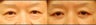 Lower Eyelid Surgery