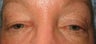 Eyelid Surgery