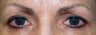 Eyelid Surgery