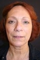 Blepharoplasty