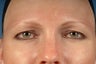 upper lid blepharoplasty (eyelid lift)