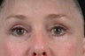 lower blepharoplasty