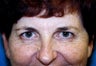 Blepharoplasty