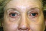 Blepharoplasty