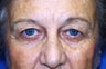 Blepharoplasty