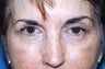 Blepharoplasty