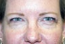 Blepharoplasty