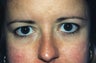 Blepharoplasty