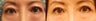 Upper eyelid surgery