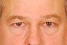 Upper and lower blepharoplasty, Browlift