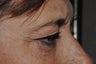 Eyelid Surgery