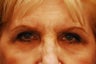 Upper Blepharoplasty