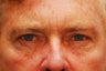 Upper and Lower Blepharoplasty