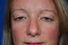 Eyelid Surgery