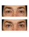 Facial Rejuvenation - Eyelid Surgery