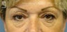 Eyelid Surgery