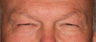 Eyelid Surgery