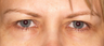 Eyelid Surgery