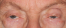 Eyelid Surgery