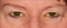 Eyelid Surgery