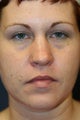Blepharoplasty Upper and Lower