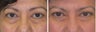 Lower Blepharoplasty