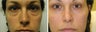 Lower Blepharoplasty - Transconjunctival