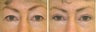 Upper blepharoplasty