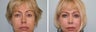 Upper blepharoplasty