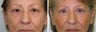 Upper blepharoplasty