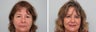 Upper blepharoplasty