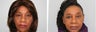 Lower blepharoplasty