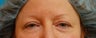 Eyelid Surgery