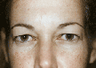 Eyelid Surgery