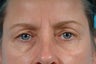 blepharoplasty with ptosis correction (eyelid surgery)