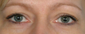 Eyelid Surgery