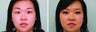 Double Eyelid Surgery Suture