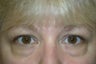 Eyelid Surgery