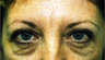Eyelid Surgery