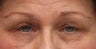 Eyelid Surgery