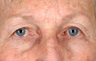 Eyelid Surgery