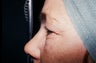 upper and lower eyelid blepharoplasty
