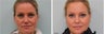 Upper blepharoplasty