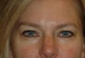 Eyelid Surgery