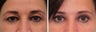 Upper Blepharoplasty