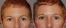 Upper blepharoplasty and brawlift