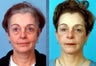 She underwent upper blepharoplasty or upper eyelid surgery and brawlift procedures.  
