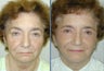 Patient will be haveing Blepharoplasty along with upper and lower eyelid lift.