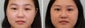 Double Eyelid (Asian Blepharoplasty) Incisional